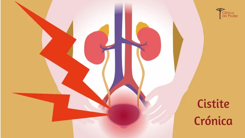 Cistite Crónica - Dr. José Pereira da Silva